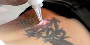 Get rid of your bad Tattoo by removing it