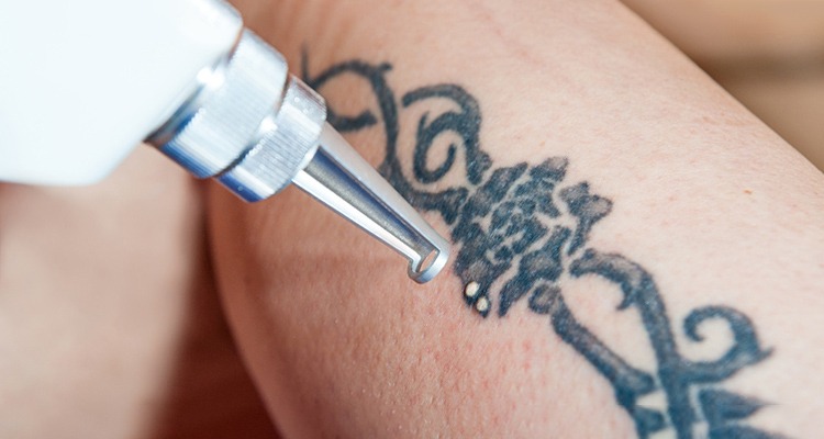How to Care for a Tattoo During Removal