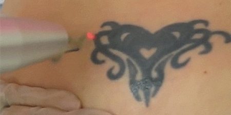 Remove tattoo from laser