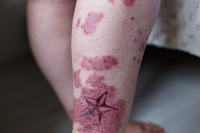 infected tattoo image