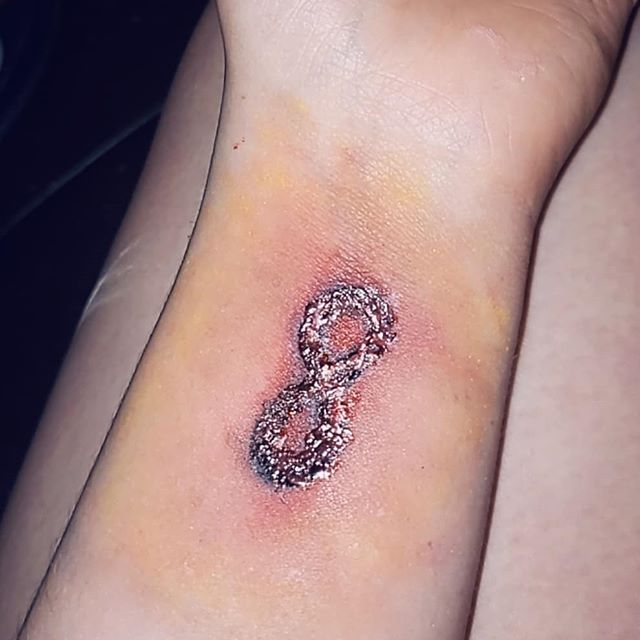 tattoo infection image