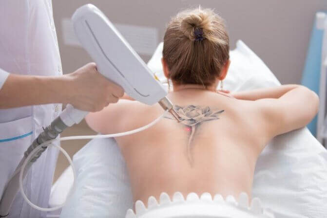Tattoo Removal Treatments
