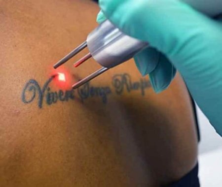 Laser Tattoo removal