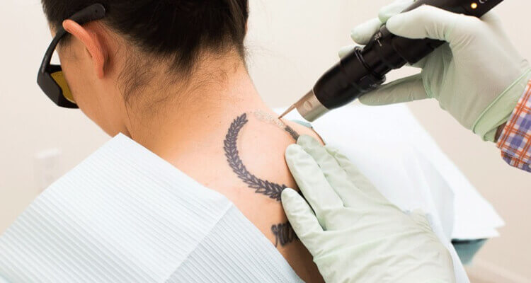 Removing Tattoo