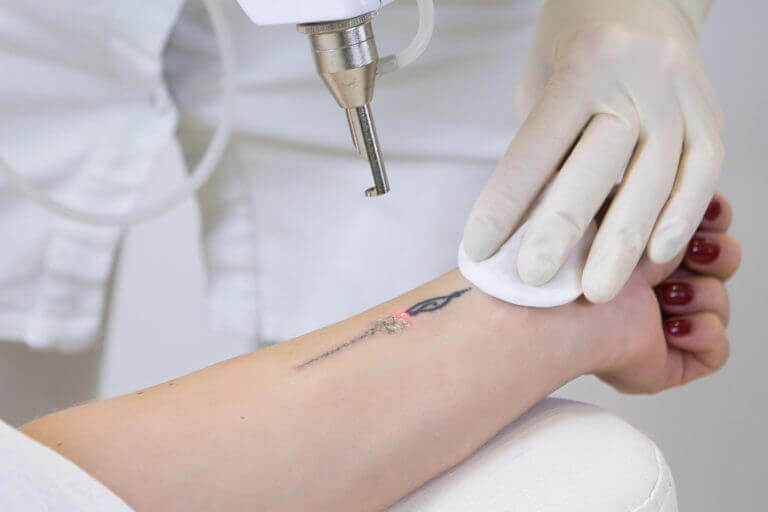 Laser tattoo removal image