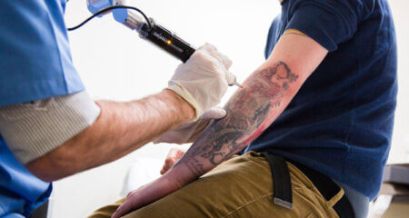 Top 5 Tattoo Removal Places in London