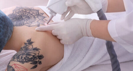 6 Common Myths About Tattoo Removal