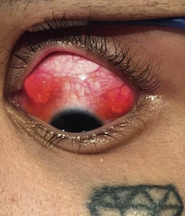 Eyeball tattoos can cause several medical conditions