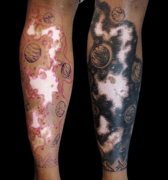 Tattoo on Vitiligo Spot
