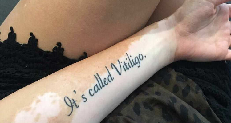 Vitiligo with Tattoo on Forearm
