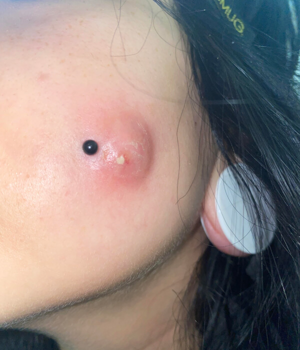 Side effects of Dimple piercing