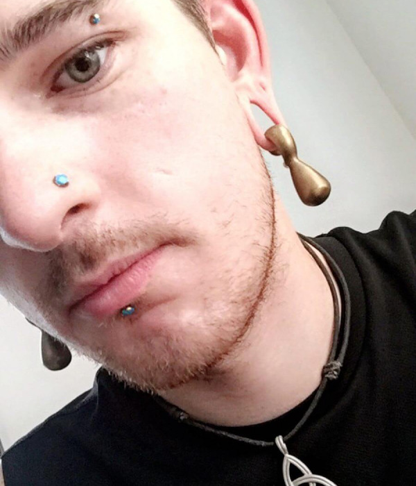 Healing from Vertical Labret Piercing