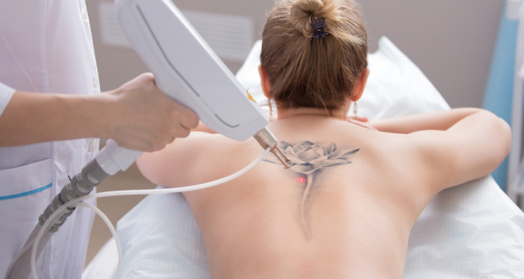 Facts About Tattoo Removal