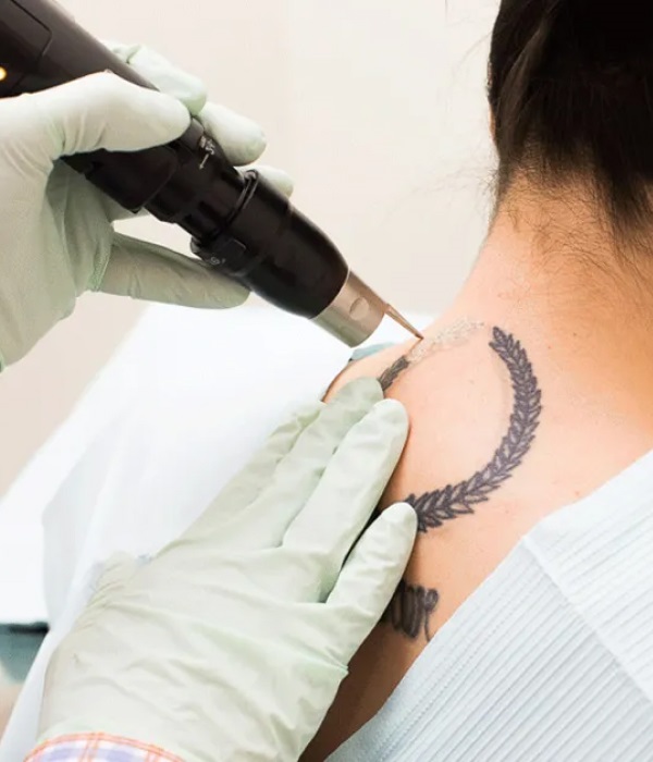 How can tattoos be erased?