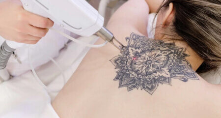 How to Prepare for Your First Tattoo Removal Session