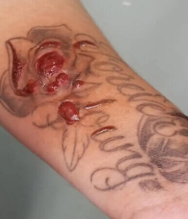 Health Issues - Trend Tattoos Tattoo health issues